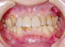 �I�[���Z���~�b�N���� �r�t�H�A�[