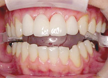 �I�[���Z���~�b�N���� �A�t�^�[