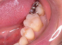 �n�C�u���b�g�Z���~�b�N �y�r�t�H�A�[�z 