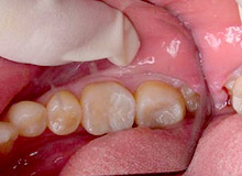 �n�C�u���b�g�Z���~�b�N �y�A�t�^�[�z