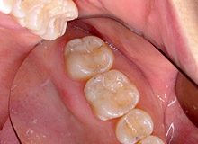 �n�C�u���b�g�Z���~�b�N �y�A�t�^�[�z