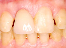 �C���v�����g ���Ì�