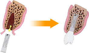 �C���v�����g